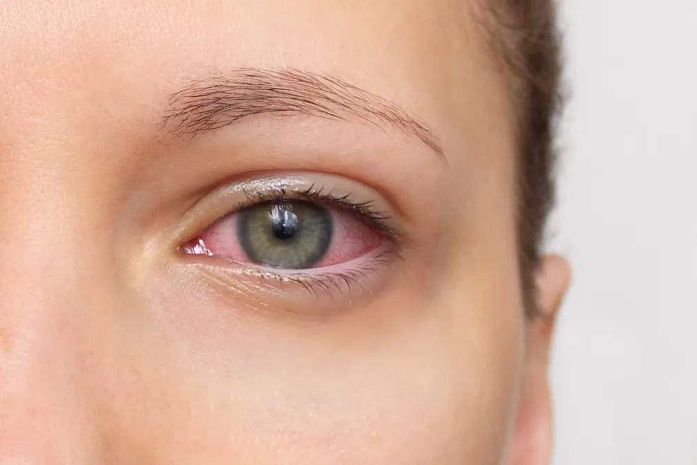 red eyes from woman with dry eye syndrome red eyes from woman with dry eye syndrome